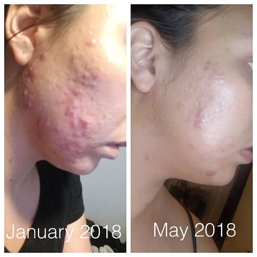 Traitement Anti-Acné Bio – Soin Purifiant Naturel
